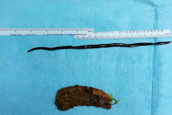 女子胃痛20年问题在胆囊 在深圳取出一条23cm的虫