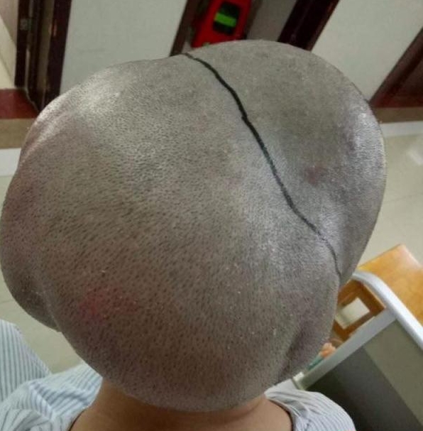 胆小者慎入!广州女子头上带瘤三十余年,脑袋是正常人的1.6倍